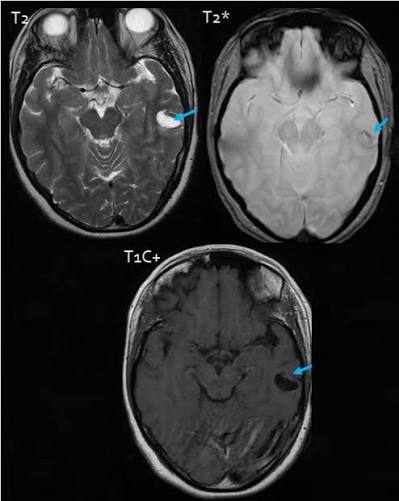Ganglioglioma in the left temporal lobe presenting as a cystic mass... | Download Scientific Diagram