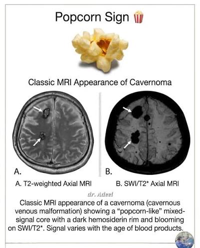 Popcorn Sign in Cavernoma MRI 🍿 Description: Classic MRI appearance of cavernous malformations showing a popcorn-like mixed signal core with hemosiderin rim and blooming on SWI/T2*. #MRI #Cavernoma #Neuroradiology #Neurology #Radiology
