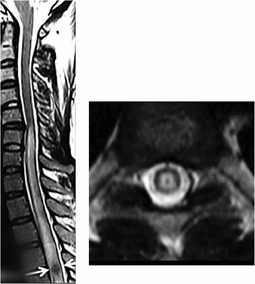 Neuro-behcet's syndrome: epidemiology, mechanisms, and emerging strategies in diagnosis and treatment | Neurological Sciences | Springer Nature Link